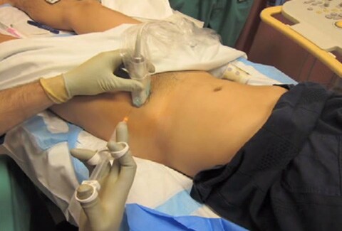 Ultrasound Guided Femoral Nerve Block for a Large Thigh Laceration