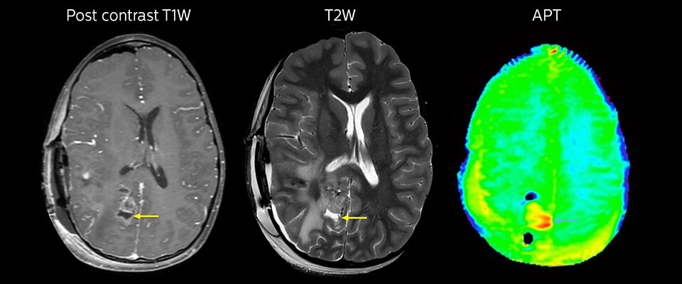 MRI with APT post resection