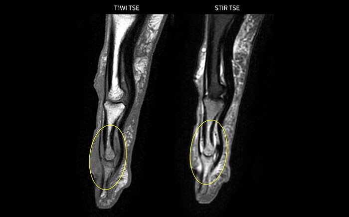 MRI of the finger