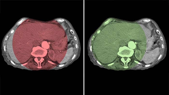 Whole liver coverage with CBCT Open