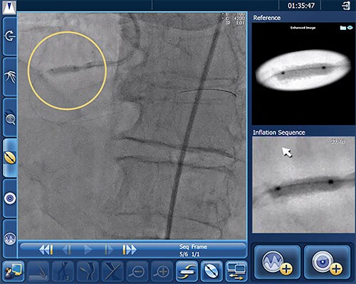 Clinical image of AngioSculpt PTCA scoring balloon catheter
