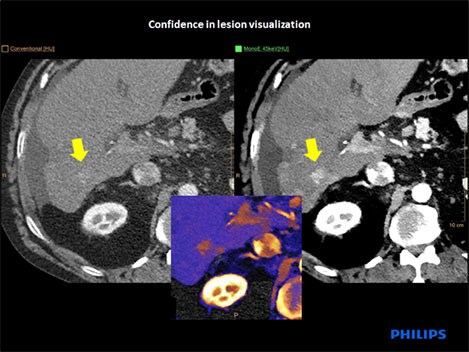 lesion visualization