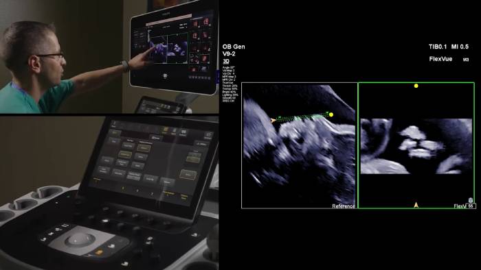 Philips V9-2 Ultrasound 3D Transducer Demonstration