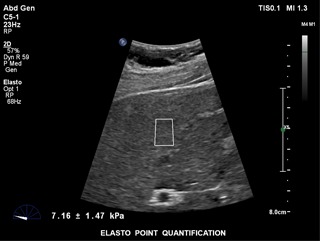 ultrasound c5-1 transducer liver abdominal ultrasound