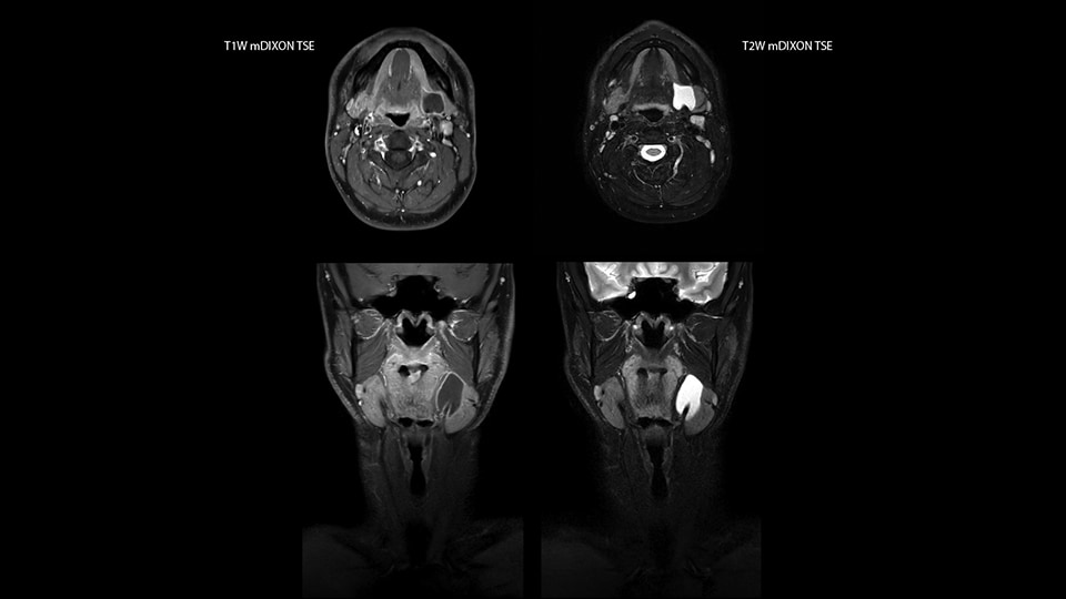 MRI of palpable lump on left side of neck