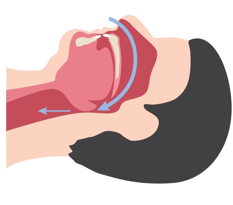 Obstructed airway